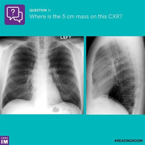 How hard is the mass csl test. Where is the 5cm mass on this CXR? | Core IM Podcast