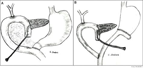 Pancreaticoduodenectomy And External Wirsung Stenting Our Outcomes In