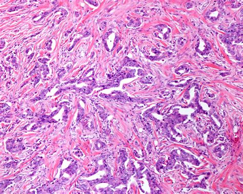 Human Breast Carcinoma Light Micrograph Stock Image C0560850