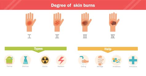 What Are Burn Injury Categories Faq Viles And Beckman Llc