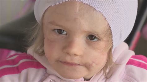 3 Year Old Girl Who Survived Gruesome Dog Attack Needs Prosthetic Ears