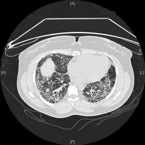 Case 2 Thoracoscopic Lung Biopsy Showing Areas Of Interstitial