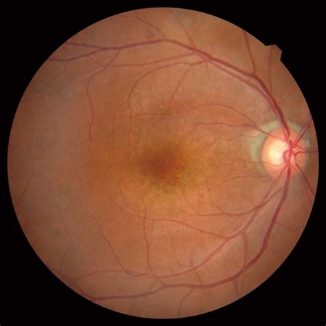 Optical Coherence Tomography Fundus Camera Retina Scan Duo™2 Retina