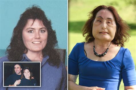 America S First Face Transplant Patient Connie Culp Who Had Surgery After Husband Blasted Her