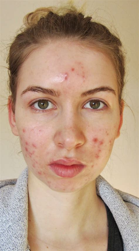 Accutane Cost Uk Roaccutane 10 Things A Doctor Wants You To Know