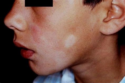 Pityriasis Versicolor Gesicht La Dermatosis De La Sem