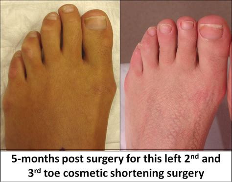 Toe Shortening Surgery Uk