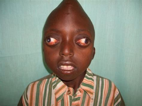 Petero Byakatonda Is A Babe From A Small Rural Town In Uganda Who Suffers From Crouzon Syndrome