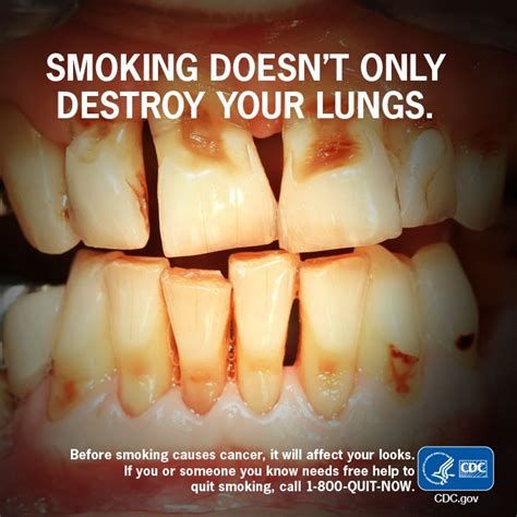 smoking is a major cause of mouth diseases such as periodontitis gum disease and oral cancer
