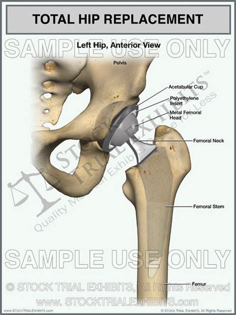 Total Hip Replacement Of The Left Hip Stock Trial Exhibits