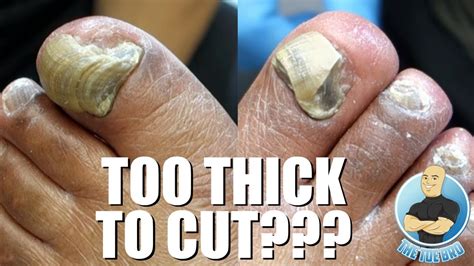 Trimming Extremely Thick Toenails Full Treatment