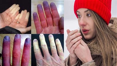 Raynauds Disease Phenomenon Tips And Proven Natural Cures Youtube