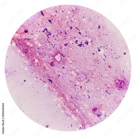 Cocci And Bacilli Bacteria In Urine Under 100x Light Microscope Smear