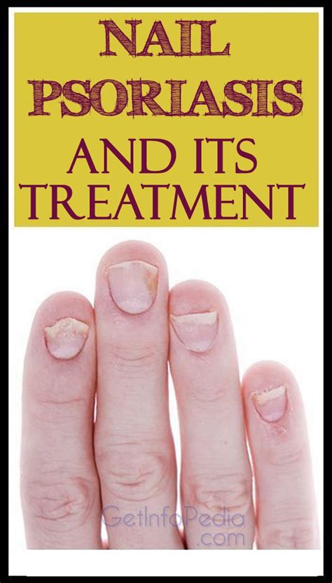 Nail Psoriasis And Its Treatment
