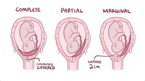 What Is Placenta Previa Causes Sign And Symptoms Complications