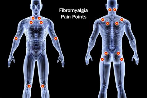 Are Pain Point Diagrams Legit Fibromyalgia