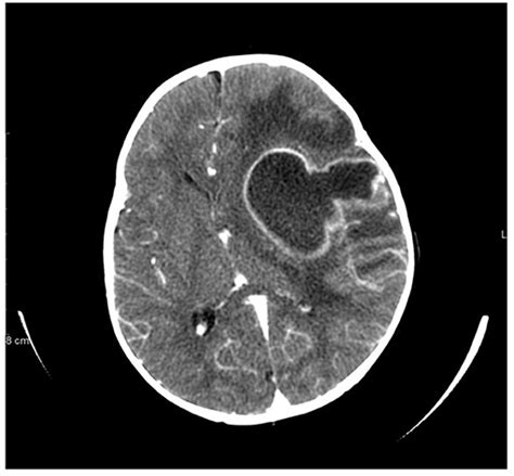Frontiers Brain Abscess As Severe Presentation Of Specific Granule
