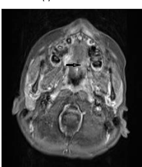 Figure 1 From Mucoepidermoid Carcinoma Of Hard Palate In A Pediatric