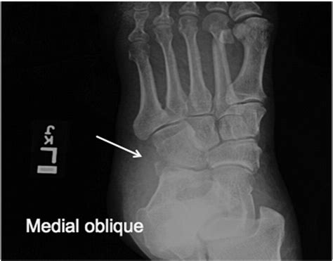 Avulsion Fractures In The Foot Telltale Radiographic Signs To Avoid