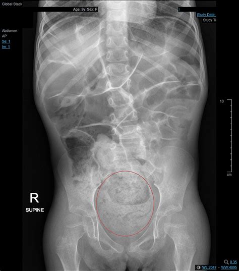 Cureus Large Bowel Obstruction Secondary To A Fecaloma In A Child