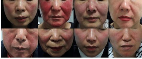Clinical Photographs Of Erythematotelangiectatic Rosacea Patients