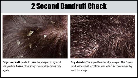 Dandruff Flakes In Hair