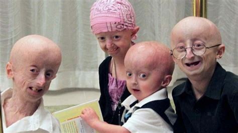 What Is Progeria Know The Causes And Symptoms Of Progeria 99 Health Ideas