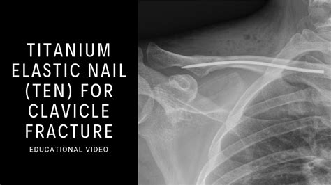 Titanium Elastic Nail Ten For Clavicle Fracture Youtube