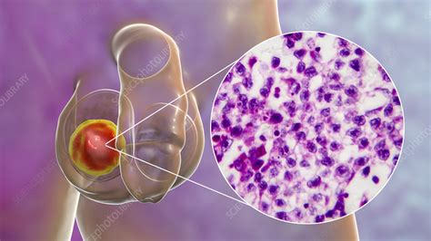 Testicular Cancer Illustration And Light Micrograph Stock Image F030 4298 Science Photo