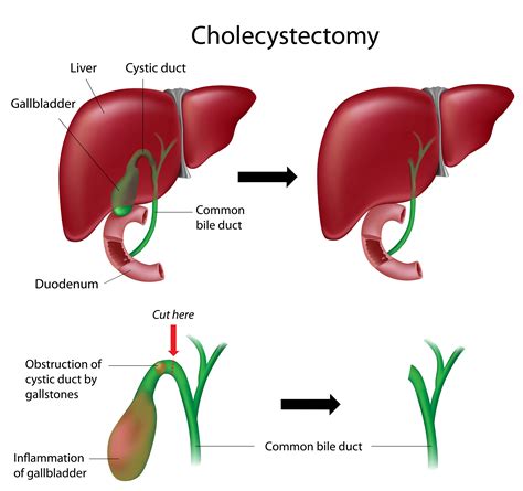 Cholecystectomy And Spl Gbmc Jordan