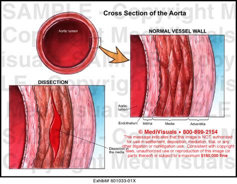 Cross Section Of The Aorta Medical Exhibit Medivisuals