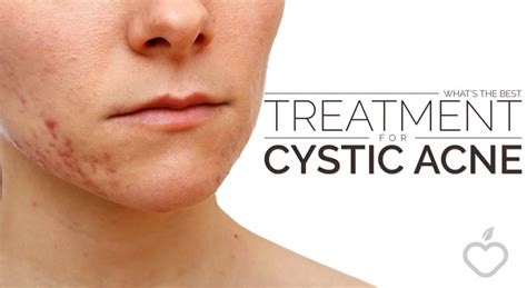Whats The Best Treatment For Cystic Acne Positive Health Wellness
