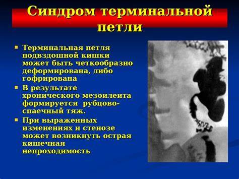Спаечная болезнь брюшной полости диета Спаечная болезнь - презентация онлайн Спаечная болезнь - презентация онлайн Спаечная болезнь брюшной полости диета