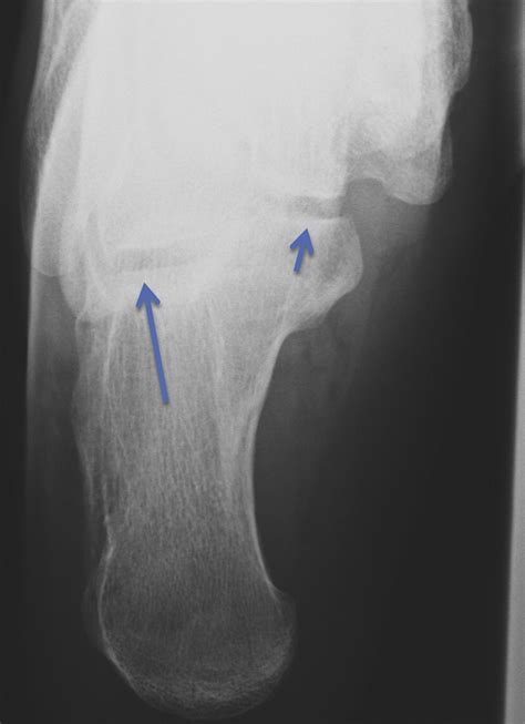 Imaging Of The Subtalar Joint Foot And Ankle Clinics
