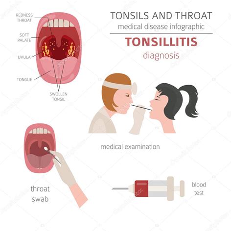 Amígdalas Y Enfermedades De La Garganta Síntomas De Amigdalitis