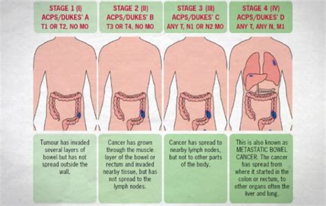 Q can liver cancer be found early? 6 Early Warning Signs Of Colon Cancer You Should Never Ignore
