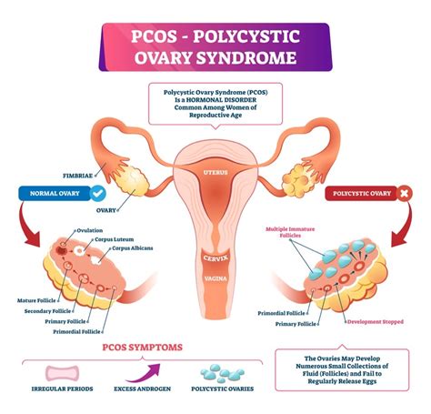 fast facts about polycystic ovary syndrome pcos the woman s clinic
