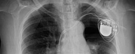 Blue monday (marcapasos & janosh rework). Marcapasos y cirugía dermatológica: ¿Cómo proceder? - DocCheck