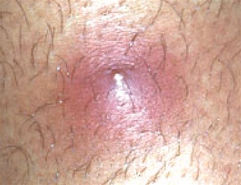 Its just the one, and it only hurts when i touch it. Ingrown hair - Pictures, Treatment, Removal and Causes ...