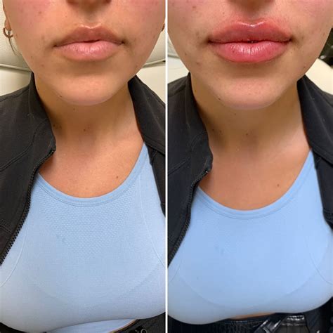 Before And After Lip Filler Lip Fillers Facial Fillers Lip Fillers