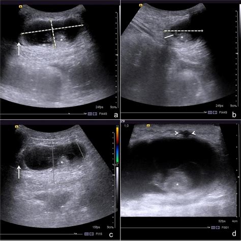 Year Old Man With Incisional Hernia Following Ventriculoperitoneal My XXX Hot Girl