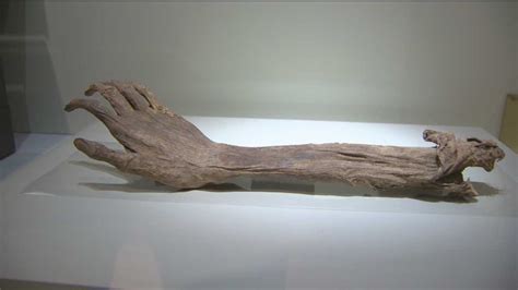 Severed Arm Grabs Spotlight At Civil War Museum