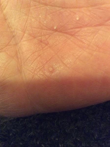 Anyone Any Idea What This Is Strange Spots On Palm Mumsnet