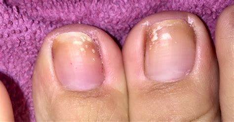 What Are These White Spots On My Toenails Fungus Or Something Theres