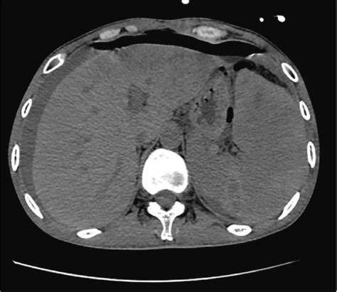 Enlarged Spleen With Visible Hypodense Areas Ct Scan Download