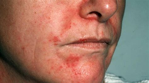 Dermatite Séborrhéique Sur Le Cuir Chevelu Et Le Visage Traitement Et