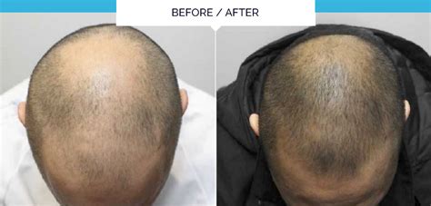 Stem cell hair growth services. Discover the revolutionary one-off treatment for thinning ...