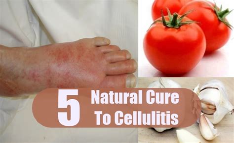 5 Natural Cures For Cellulitis How To Cure Cellulitis Naturally