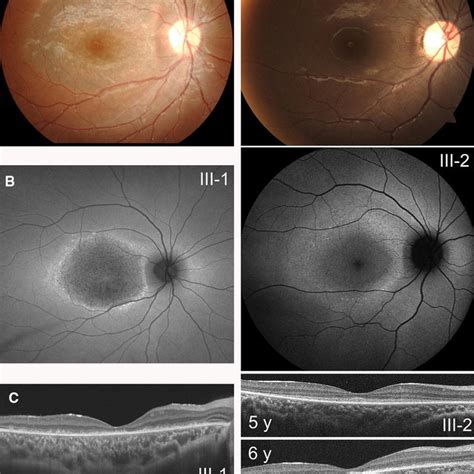 Full Field Electroretinography Erg Erg Findings Of A Control