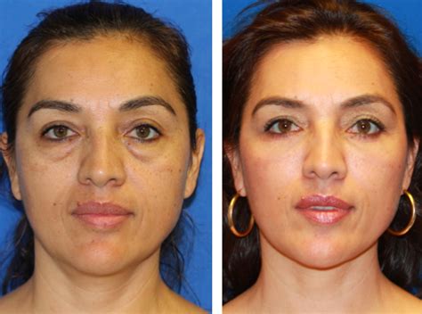 Fat Transfer Around The Eyes As Opposed To Temporary Fillers When You